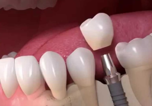 The Best UK Dental Clinics for Dental Implants